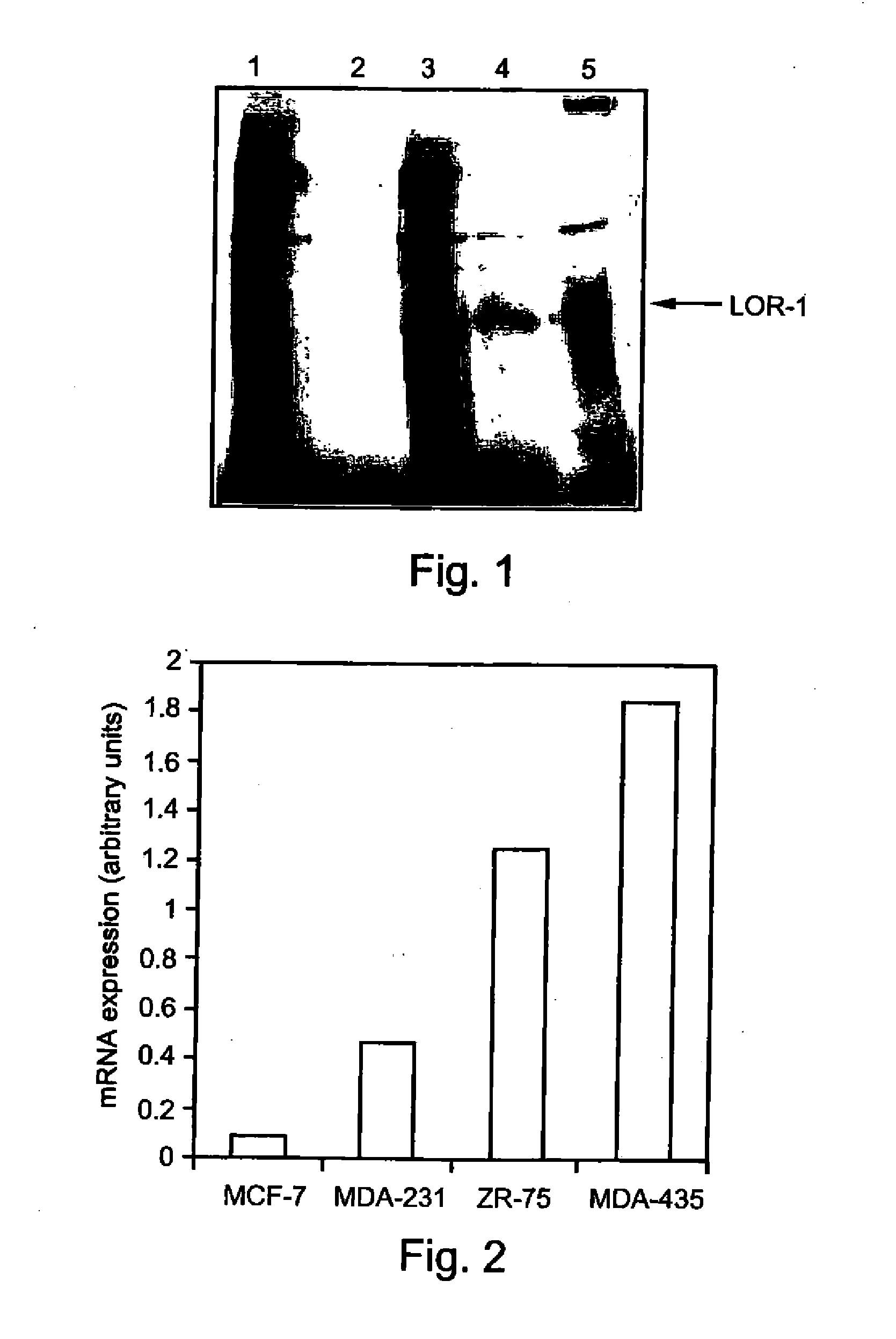 Pharmaceutical compositions and methods useful for modulating angiogenesis, inhibiting metastasis and tumor fibrosis, and assessing the malignancy of colon cancer tumors