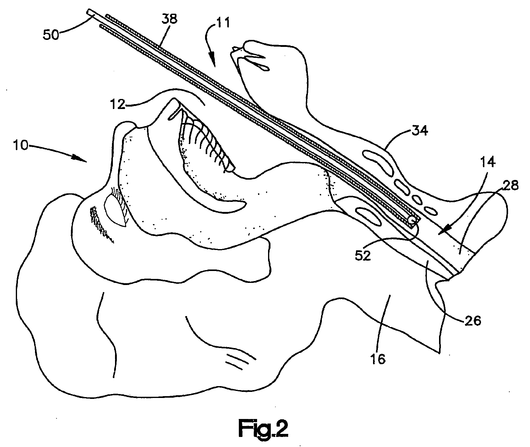 Medical device positioning system and method