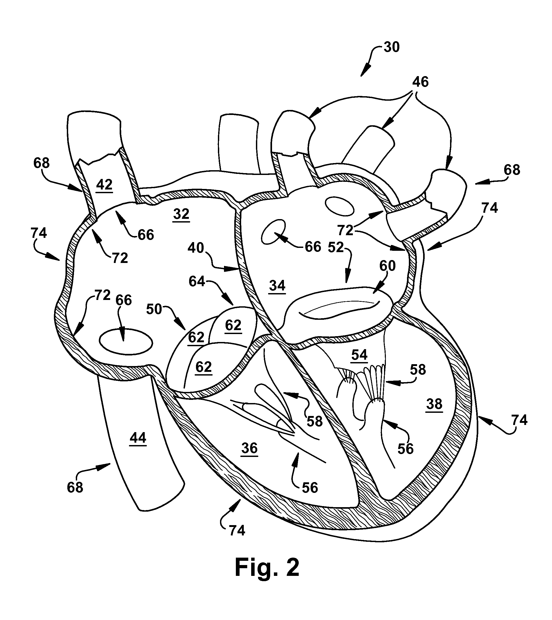 Apparatus and method for treating cardiovascular diseases