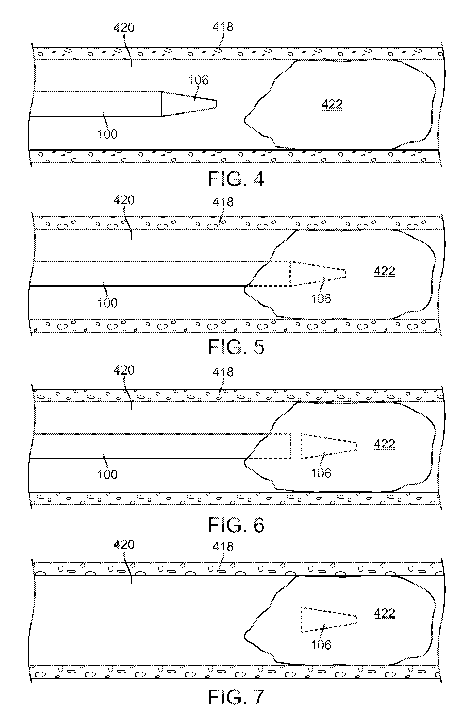 Catheter having a detachable tip