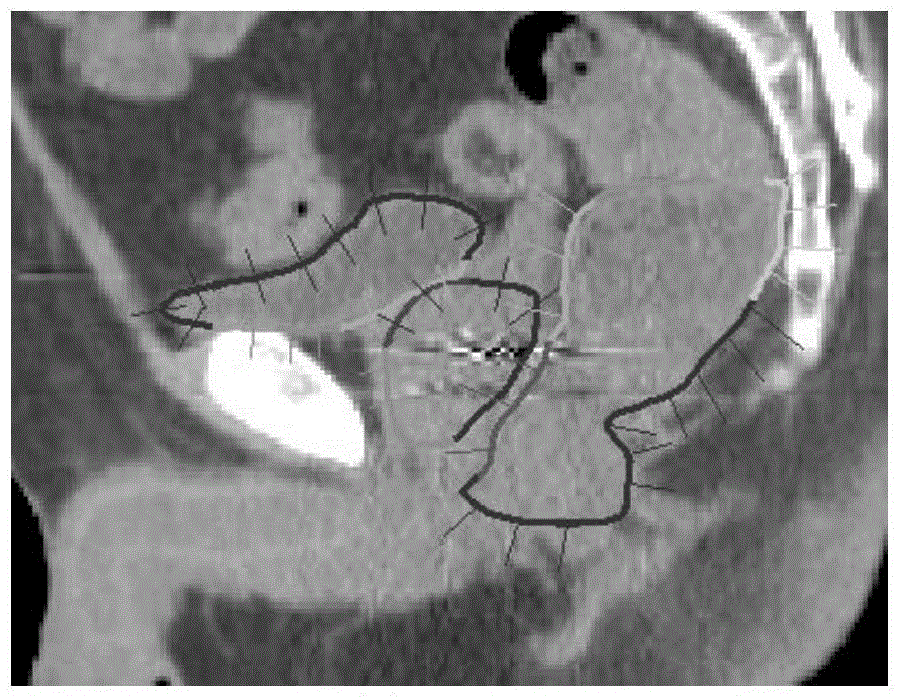 Pelvic organ automatic segmentation method for CT examination