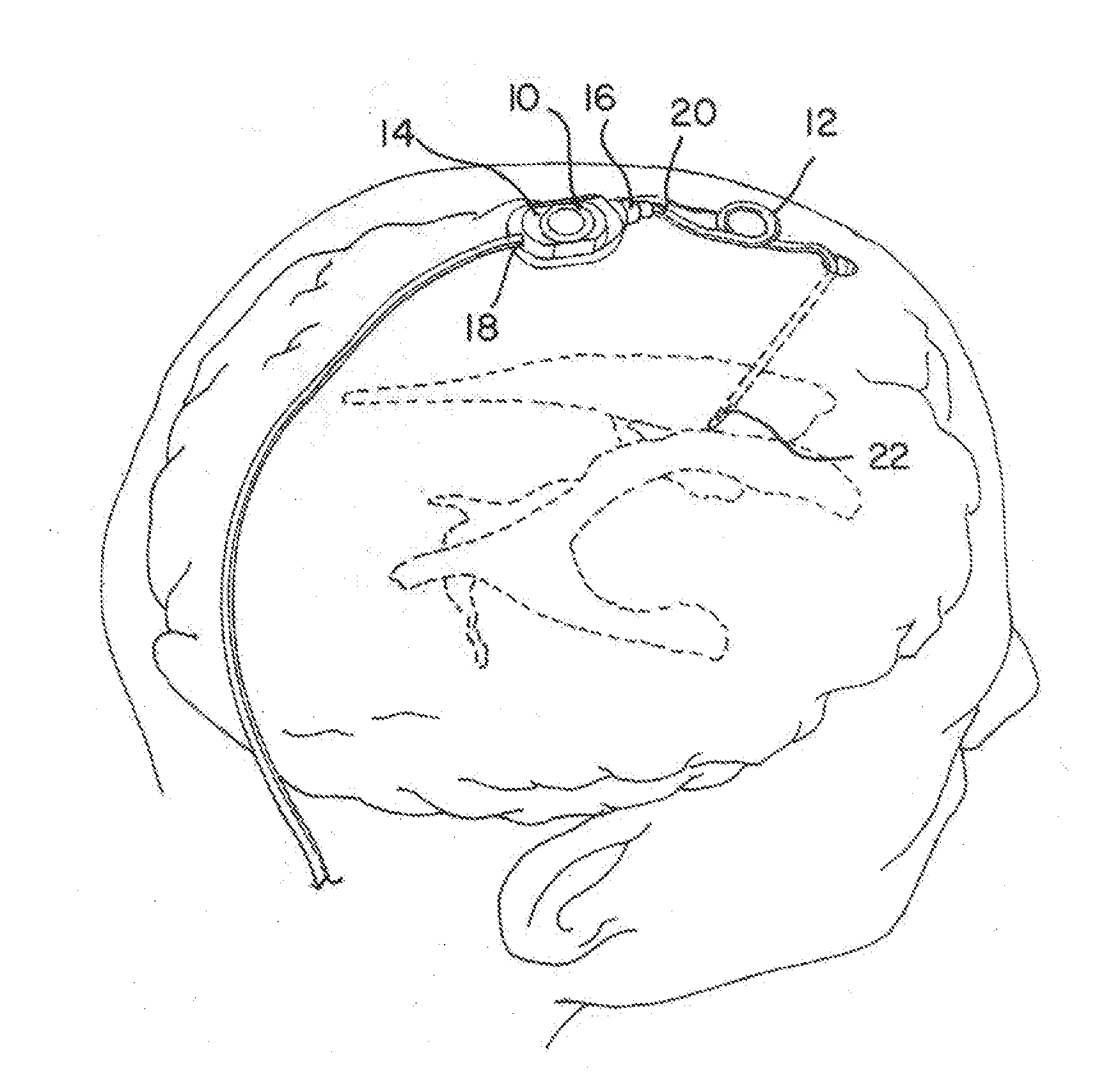 Multi-lumen ventricular drainage catheter