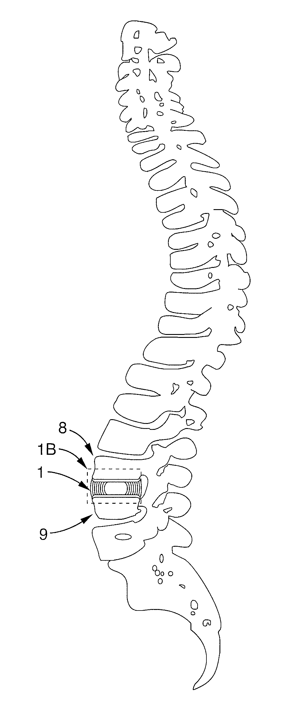 Implantable thermal treatment method and apparatus