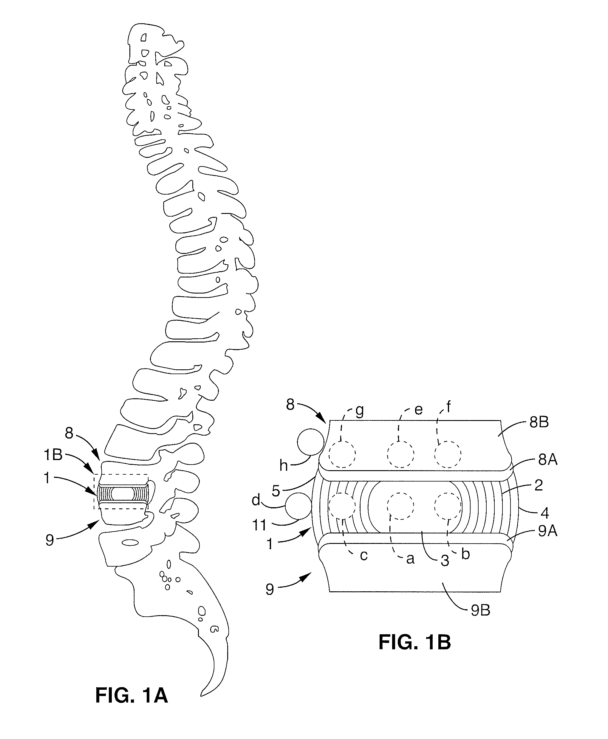 Implantable thermal treatment method and apparatus