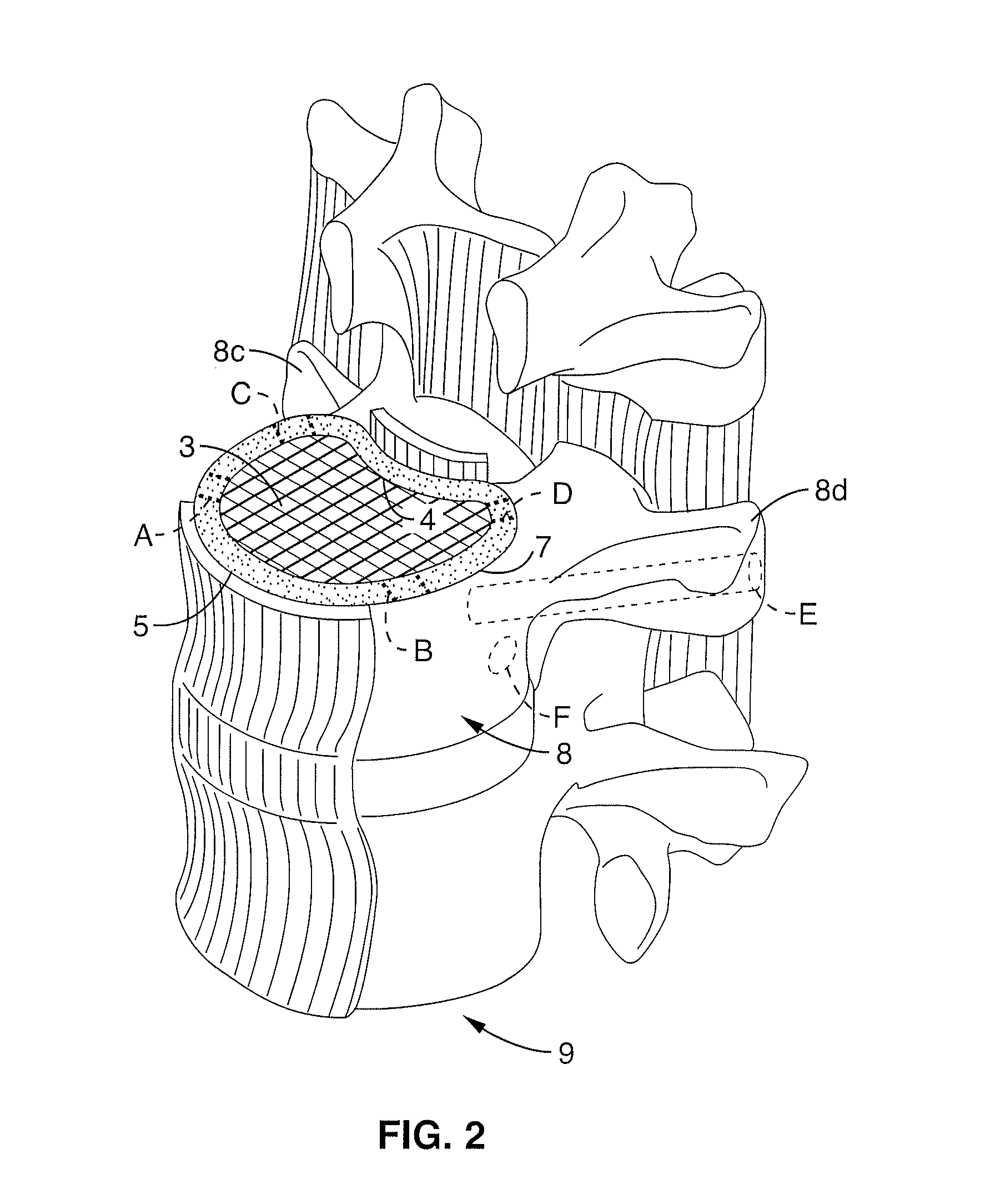 Implantable thermal treatment method and apparatus