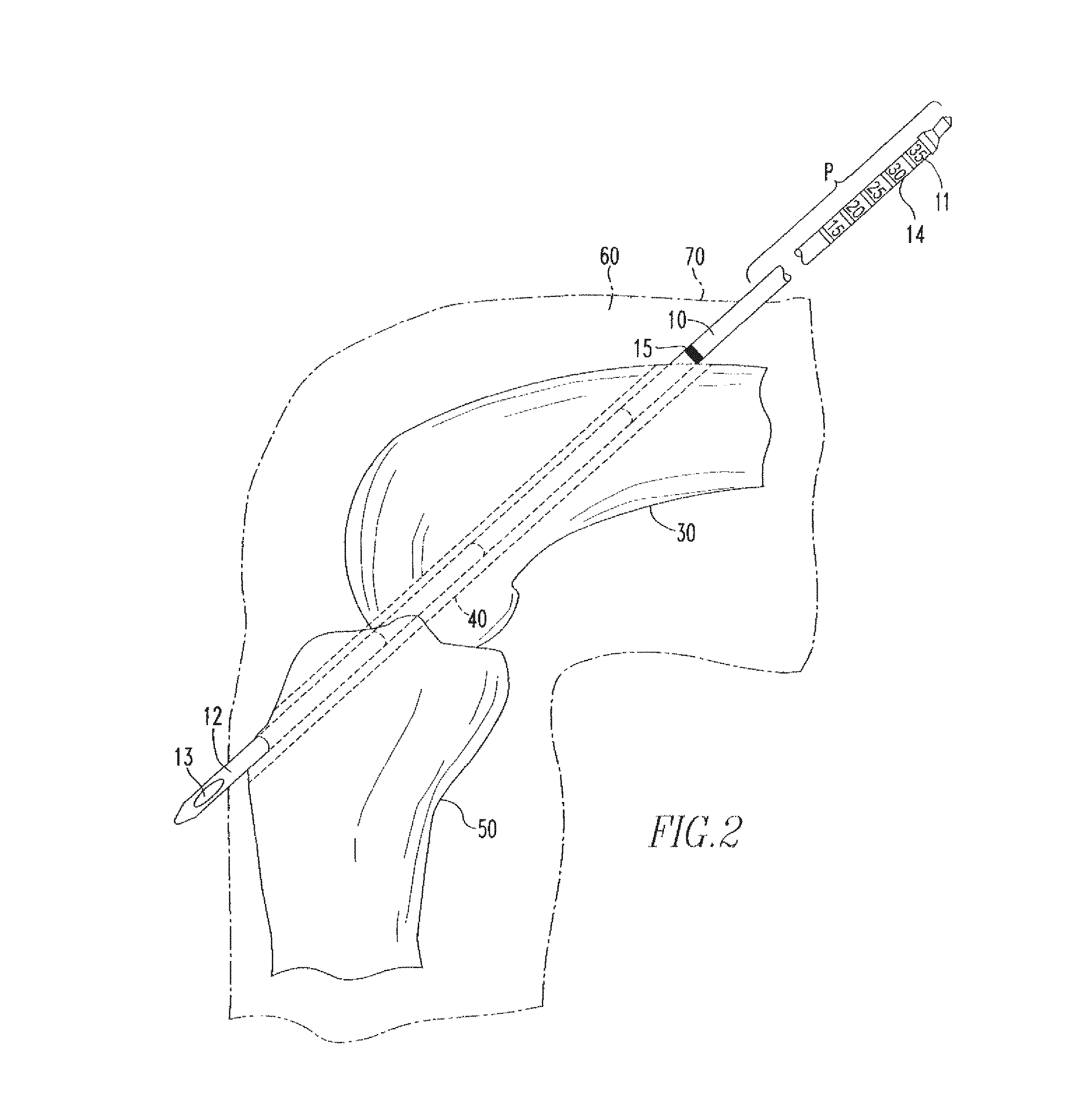 Device and method for use during ligament reconstruction surgery