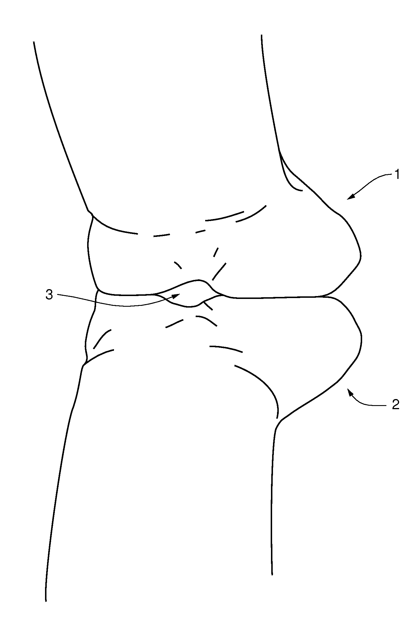 Computer mouse accoutrement (attachment) and method of preventing or alleviating carpel tunnel syndrome (CTS)