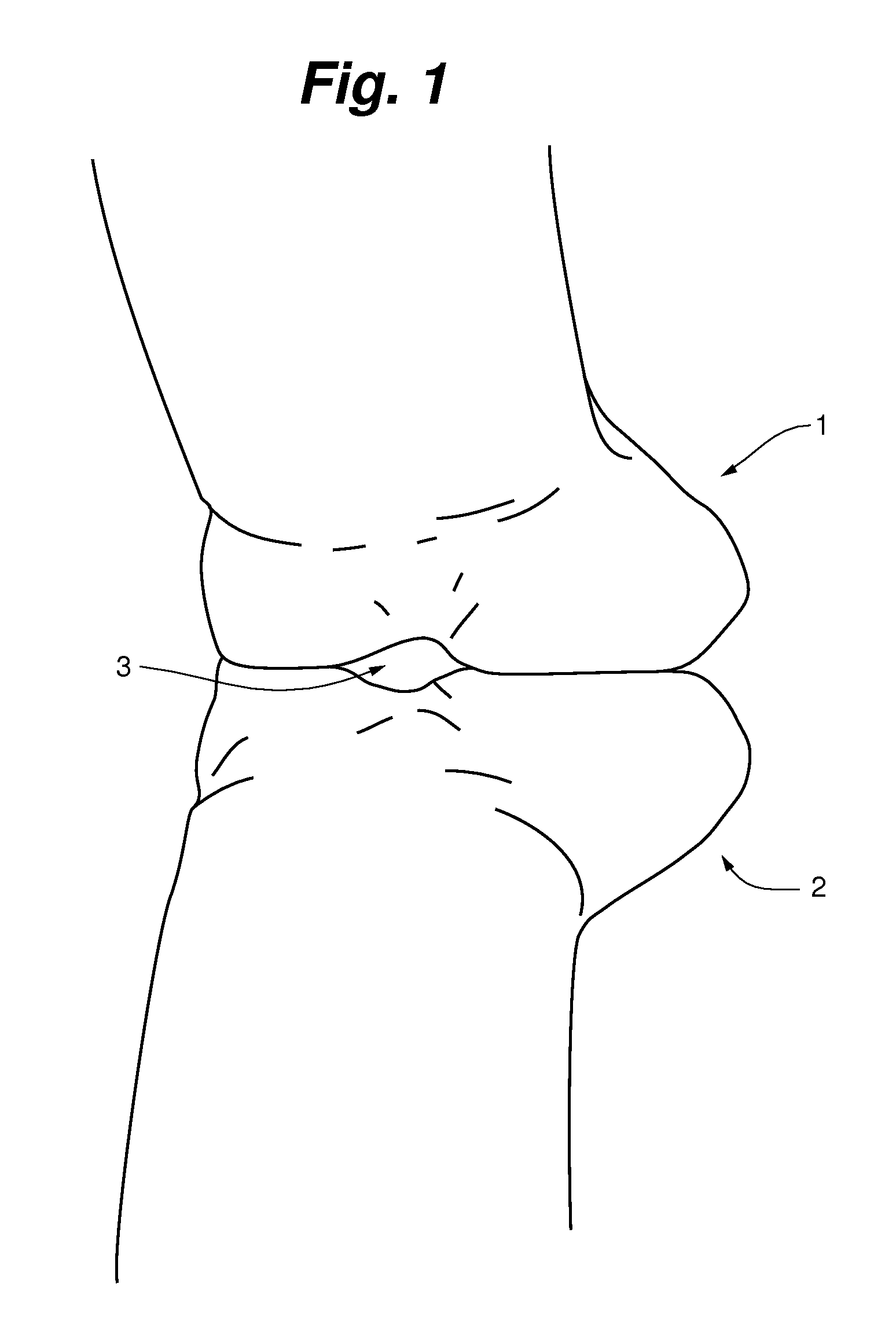 Computer mouse accoutrement (attachment) and method of preventing or alleviating carpel tunnel syndrome (CTS)