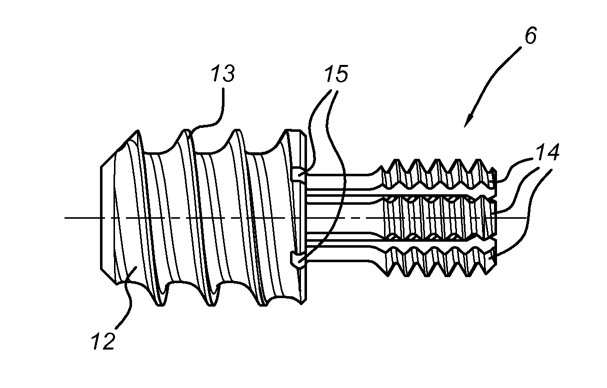 Intramedullary device for mid-shaft clavicle fractures