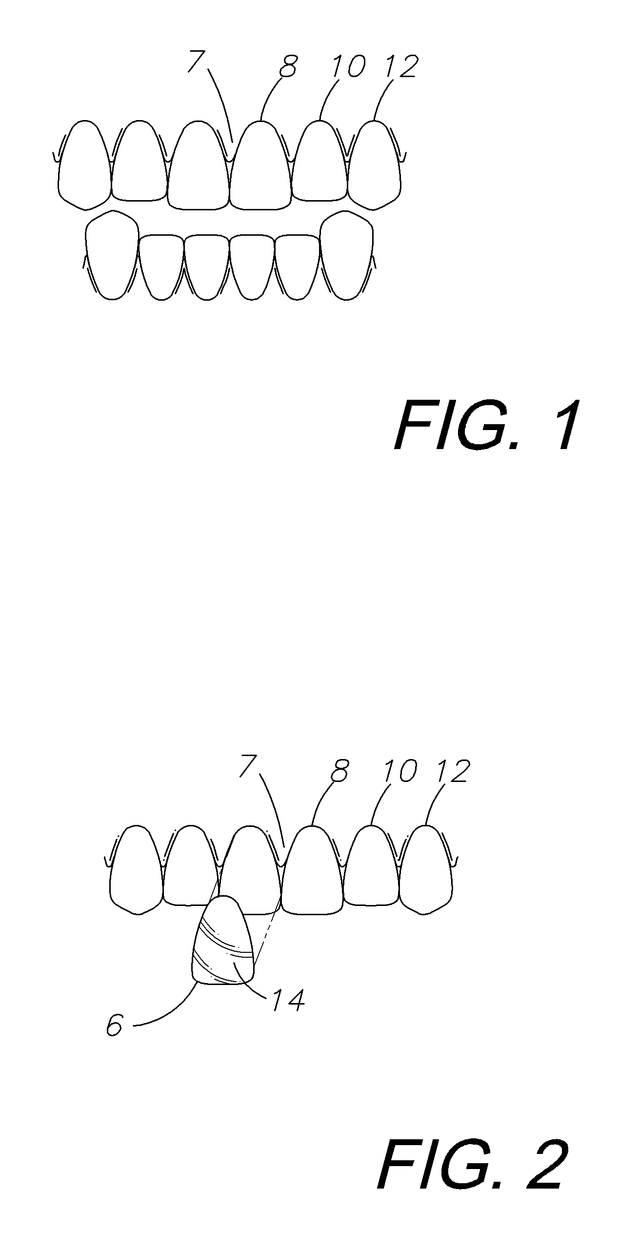 Dental veneer system and method