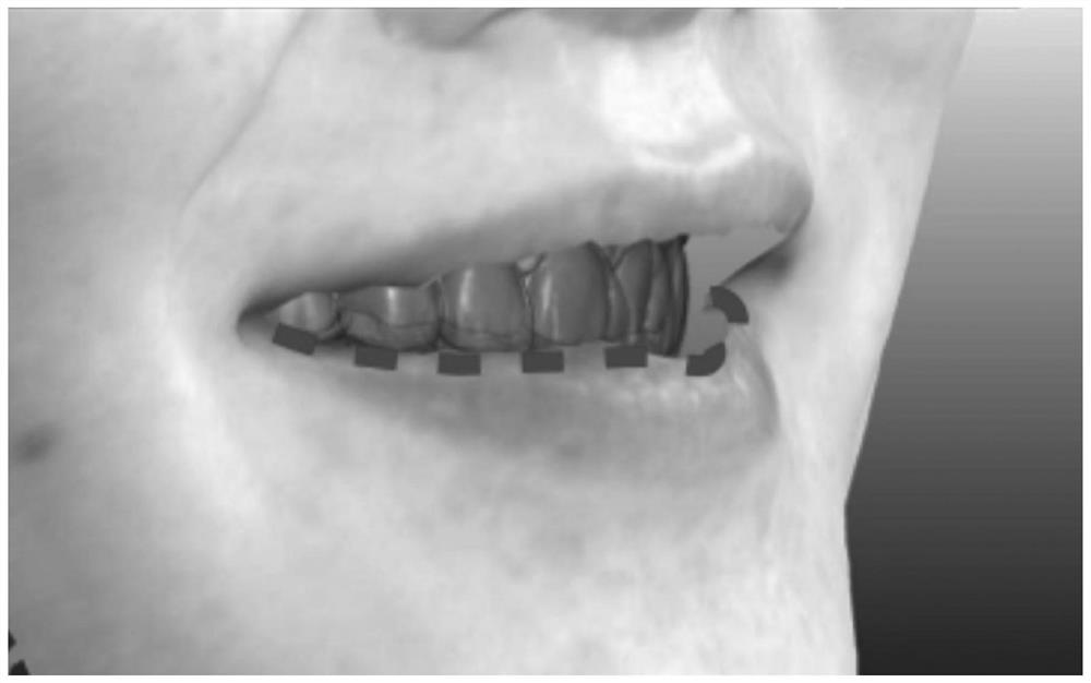 A method to improve the accuracy of facial scan image registration dentition scan image