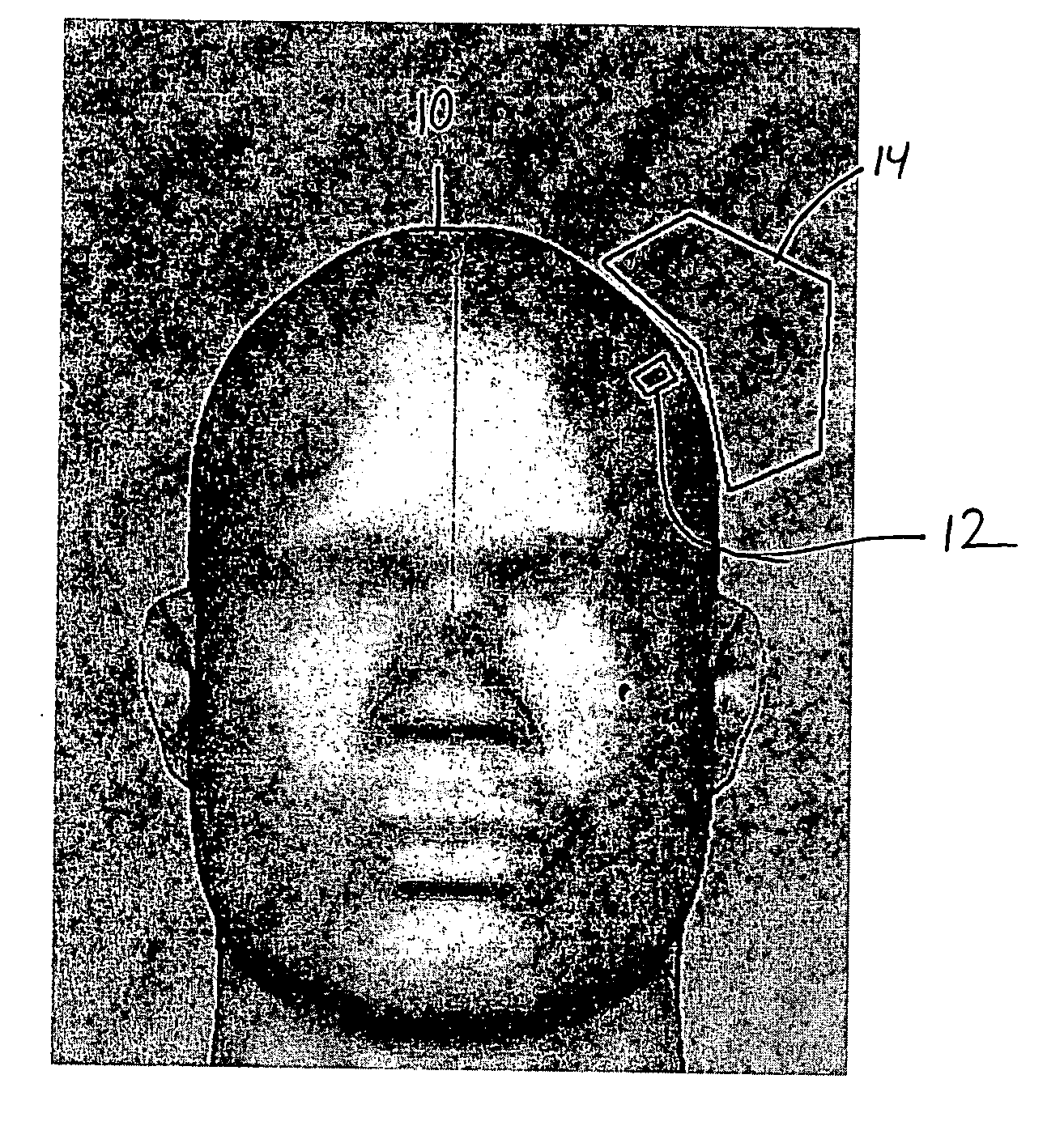 Head phantom for simulating the patient response to magnetic stimulation