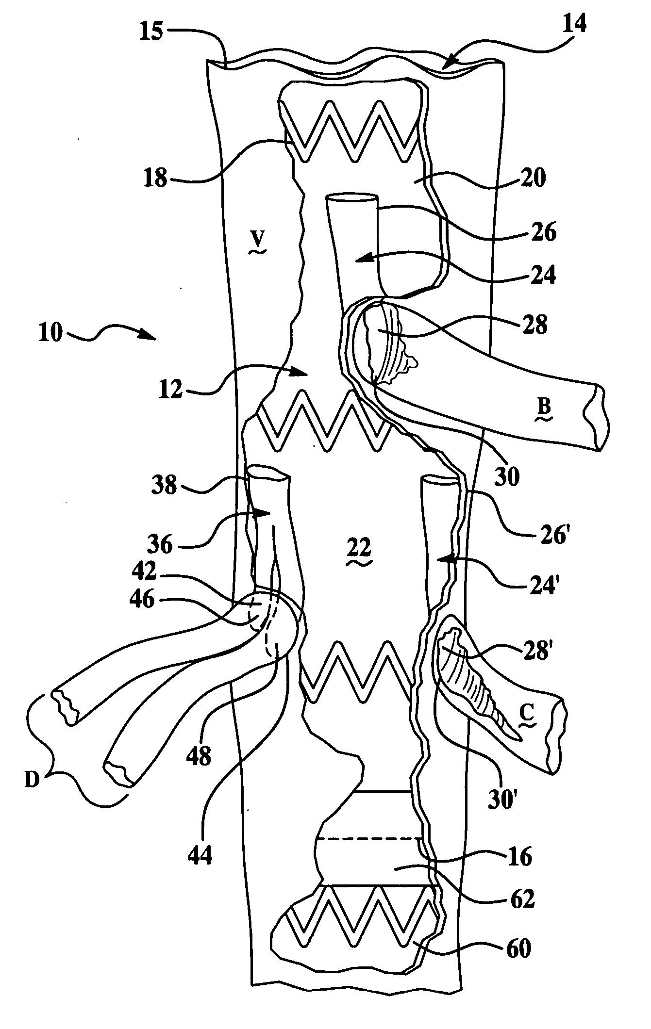 Vascular endograft