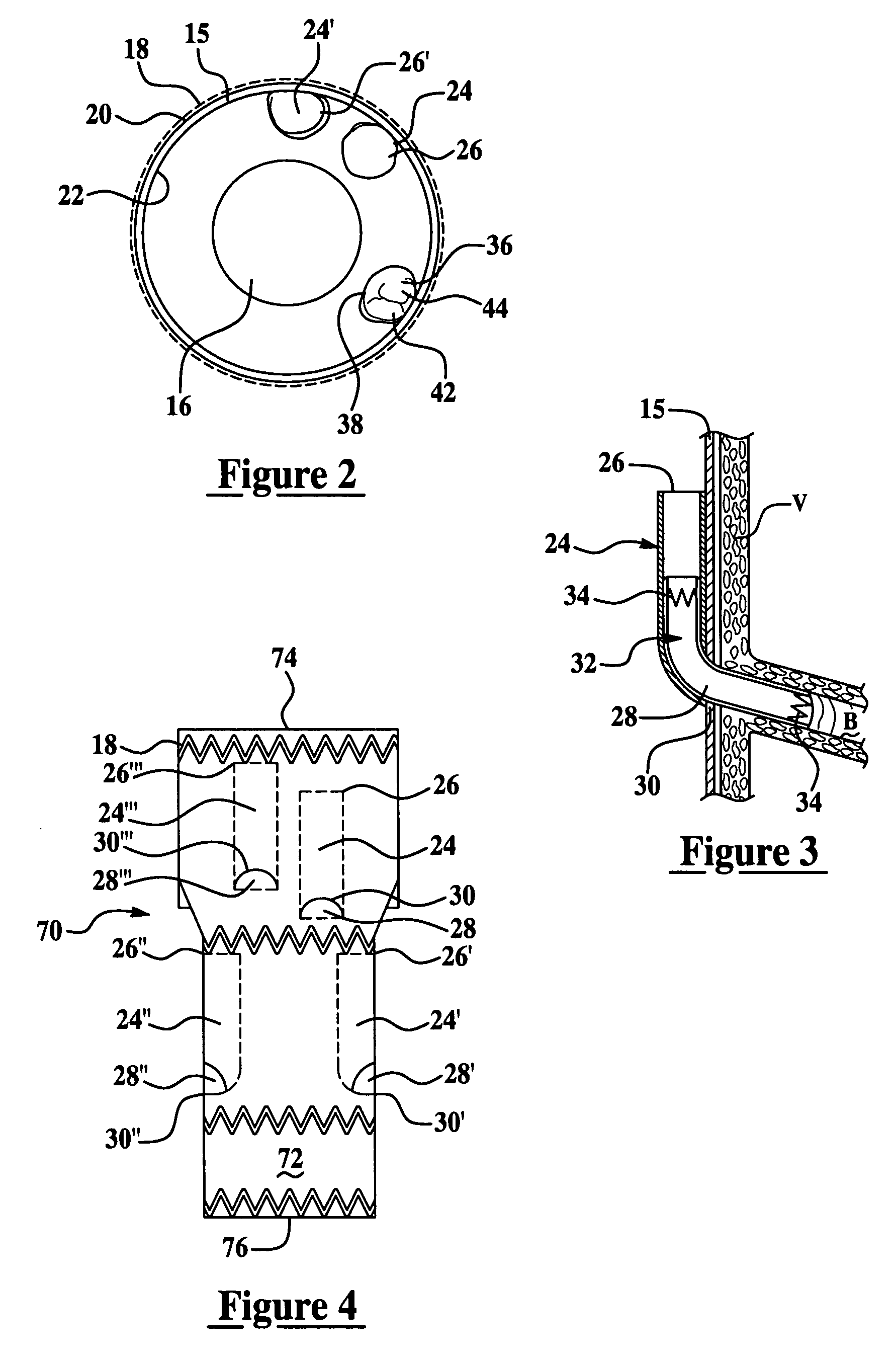 Vascular endograft