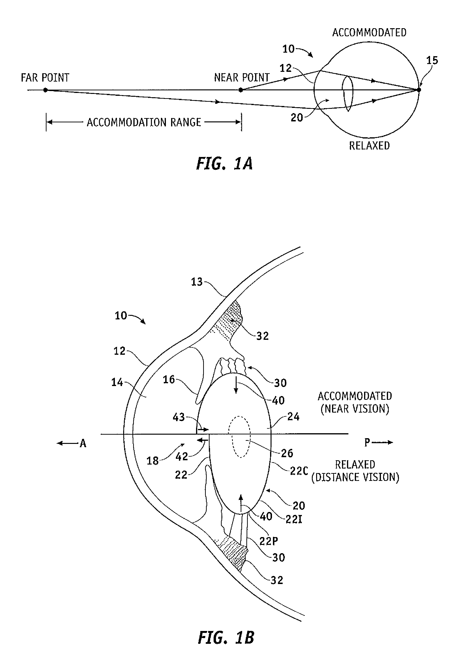 Capsular membrane treatments to increase accommodative amplitude