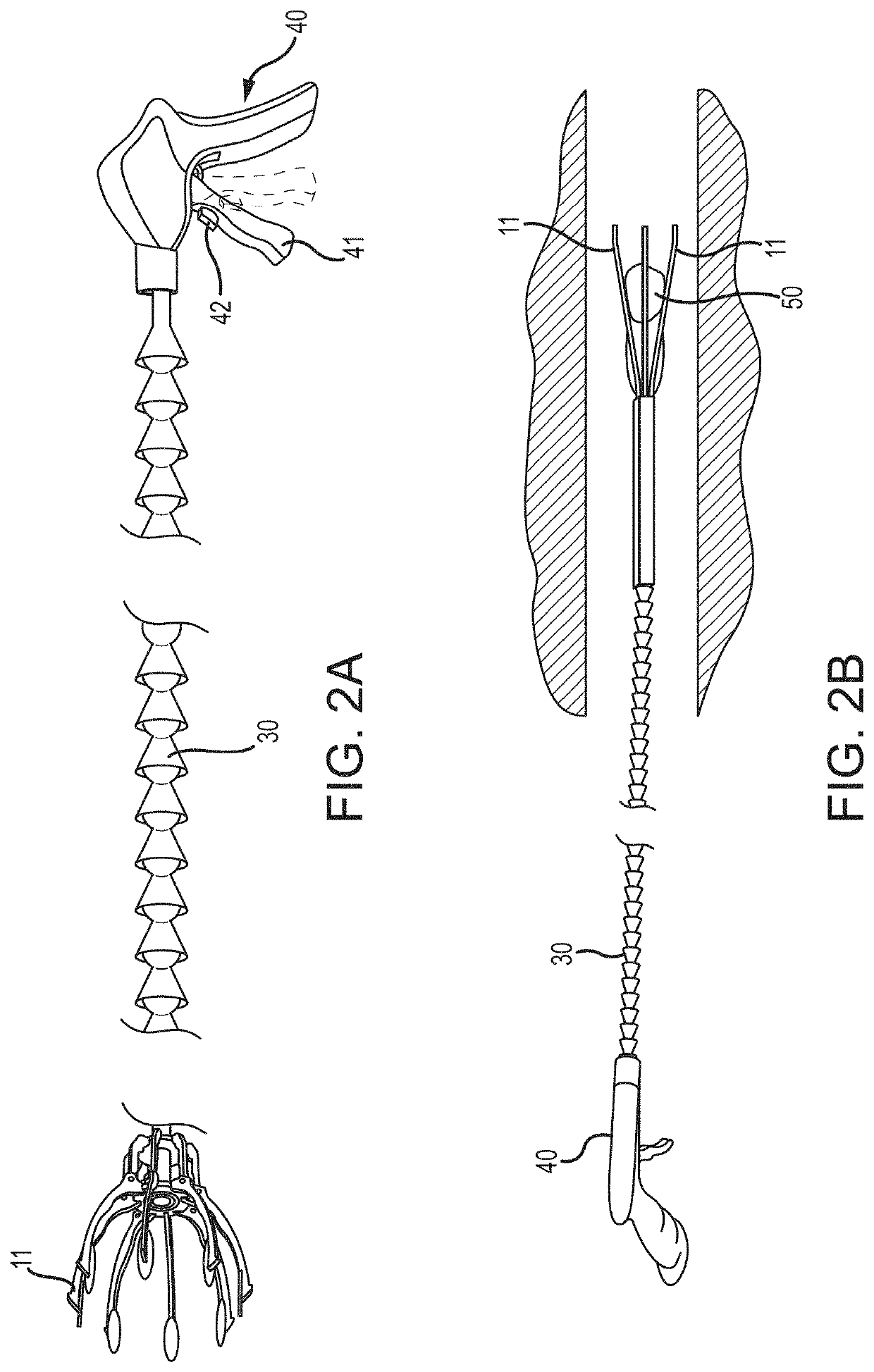 Medical Device to Remove an Obstruction from a Body Lumen, Vessel or Organ