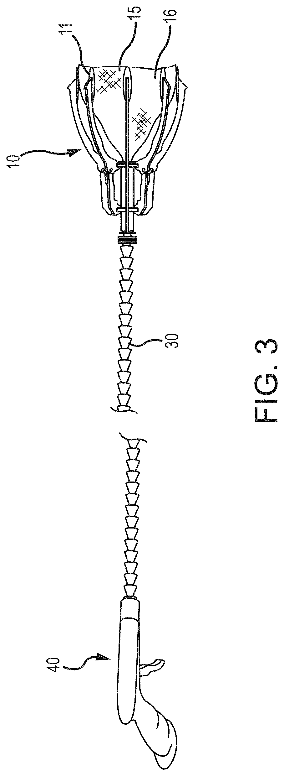 Medical Device to Remove an Obstruction from a Body Lumen, Vessel or Organ