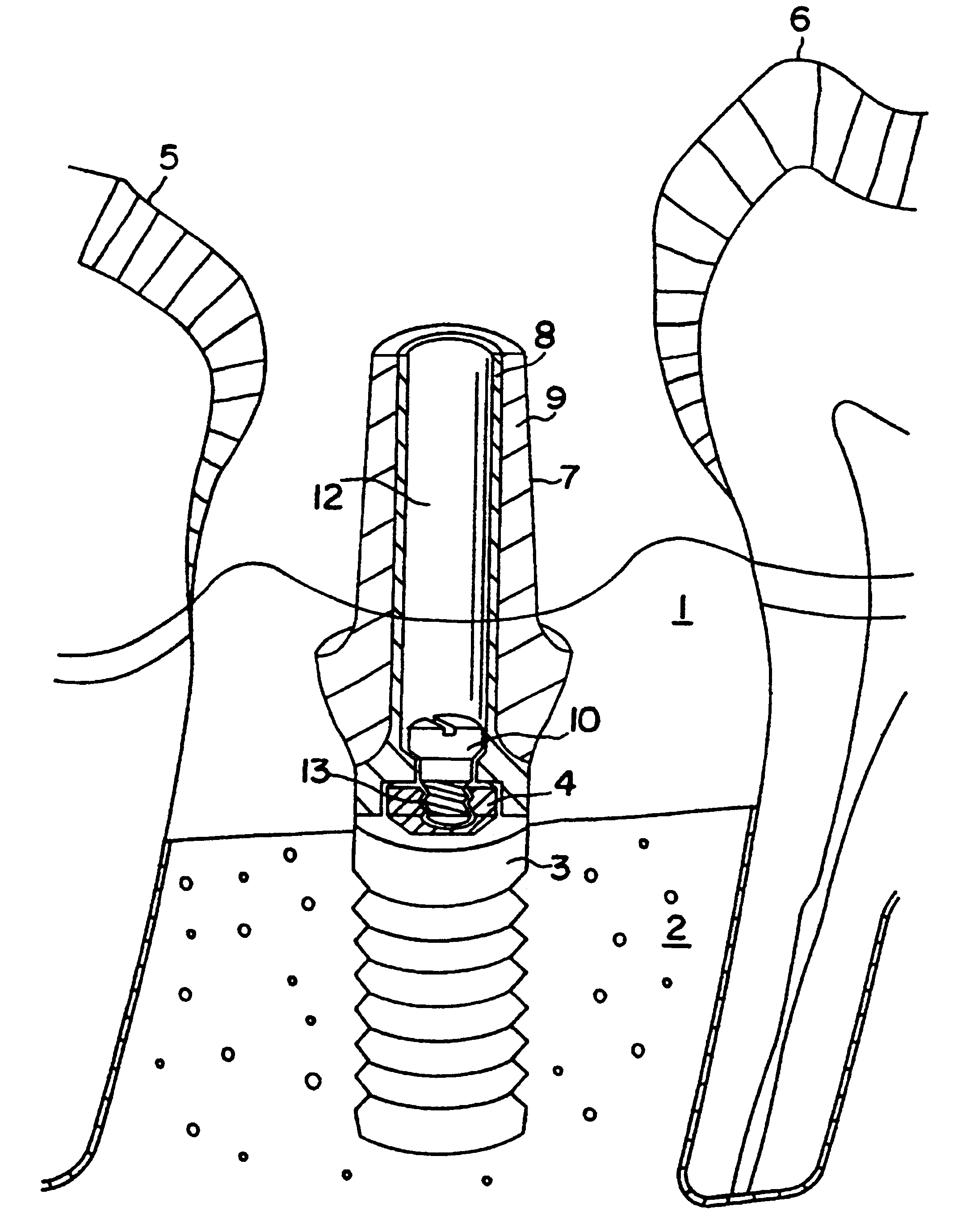 Device for the reconstruction of teeth