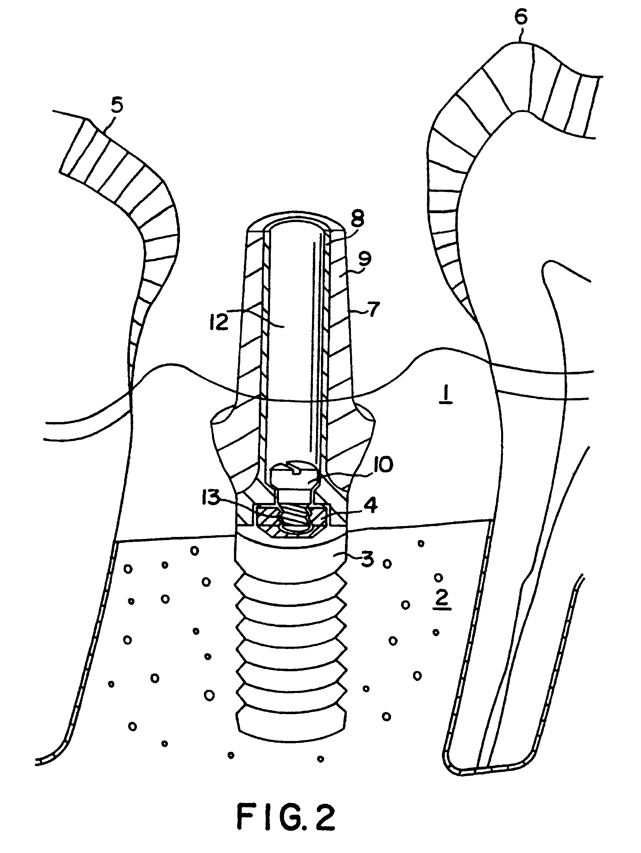 Device for the reconstruction of teeth