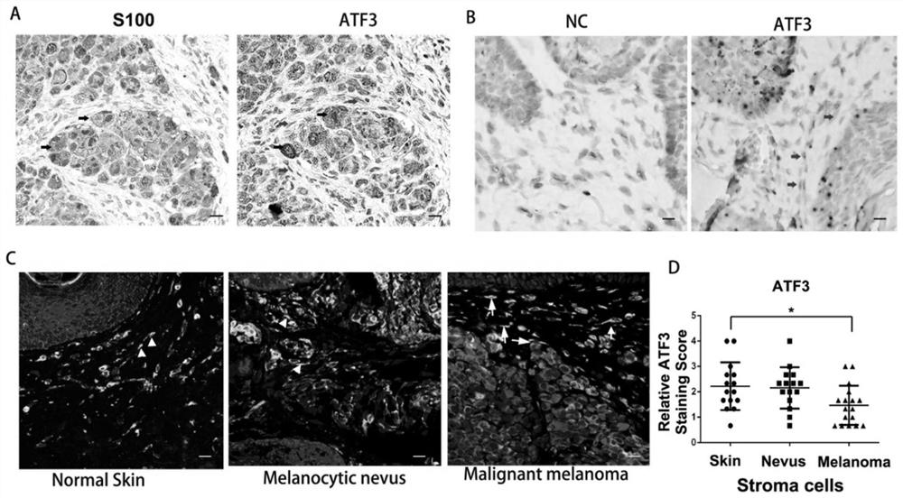 Application of dermal fibroblasts in the treatment of melanoma