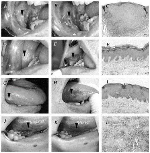 A detection kit for benign lesions and malignant lesions of oral mucosa and detection method thereof