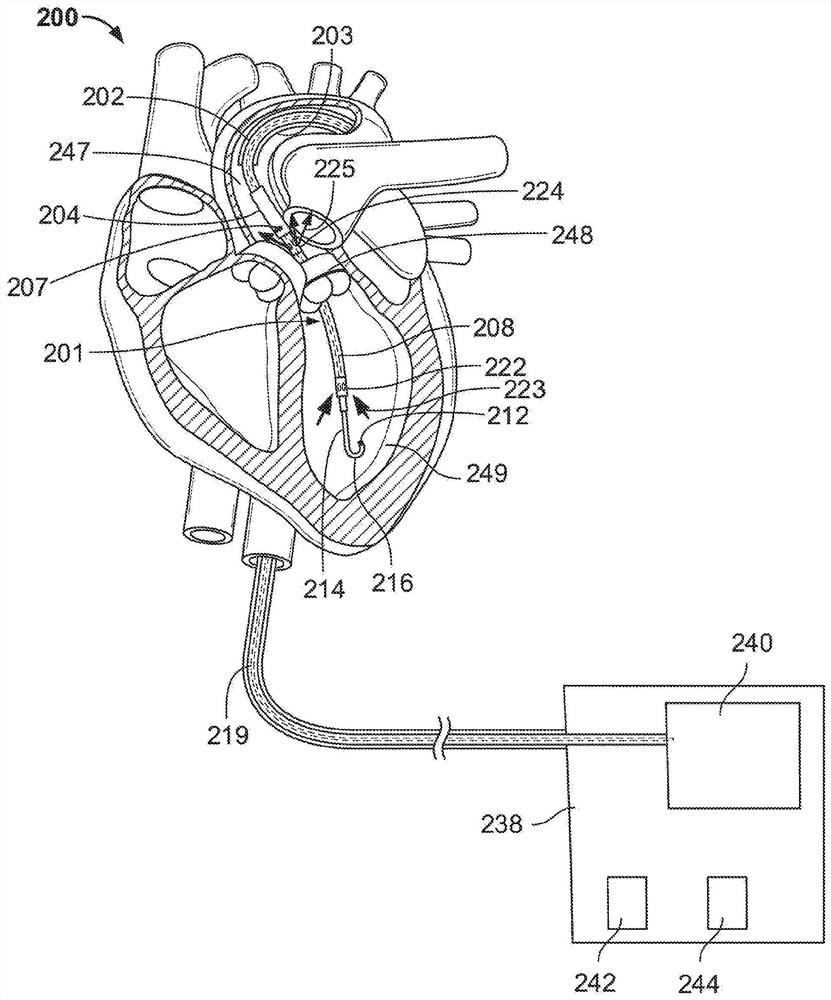 Blood pump with electrocardiogram (EKG) monitoring, defibrillation and pacing capabilities