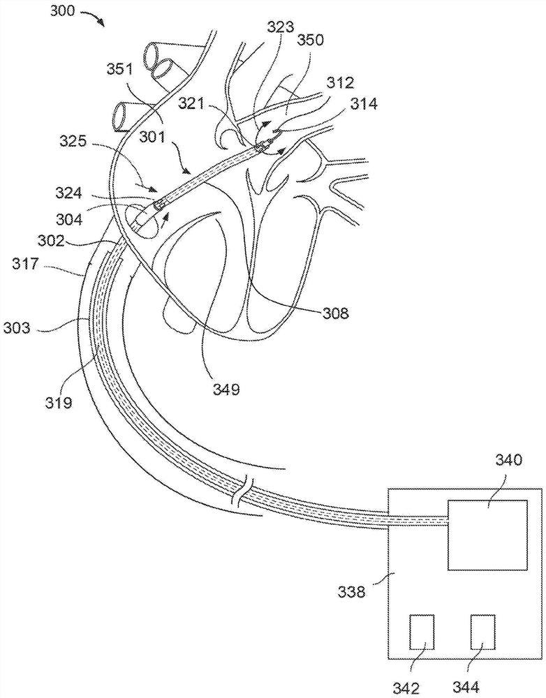 Blood pump with electrocardiogram (EKG) monitoring, defibrillation and pacing capabilities