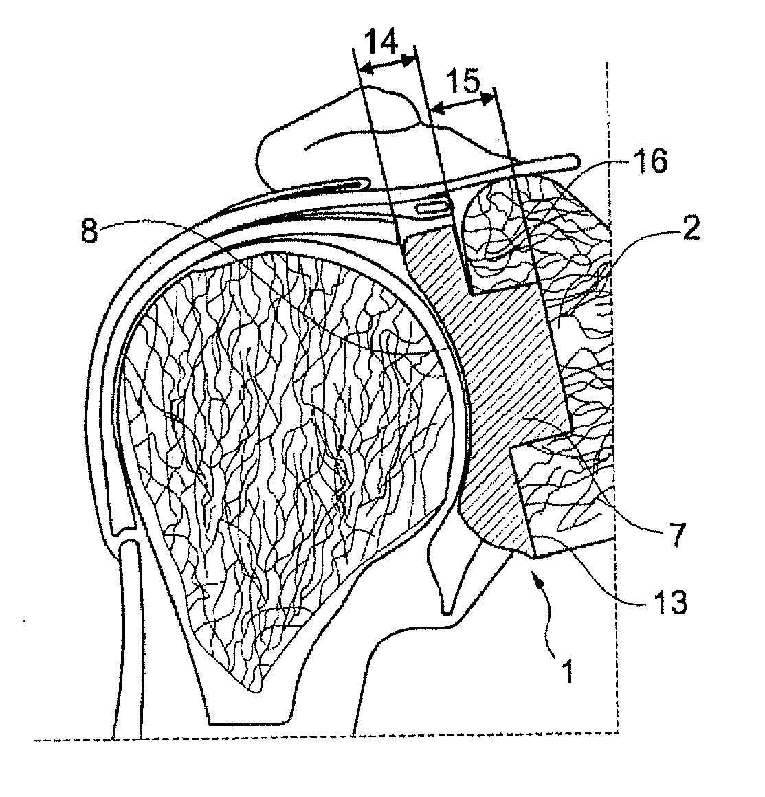 Allogenic Articular Cavity Prosthesis and Method for Implanting the Same