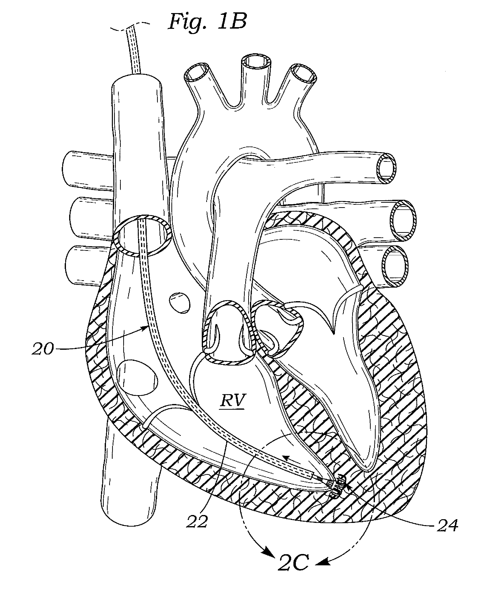 Devices and methods for reducing cardiac valve regurgitation