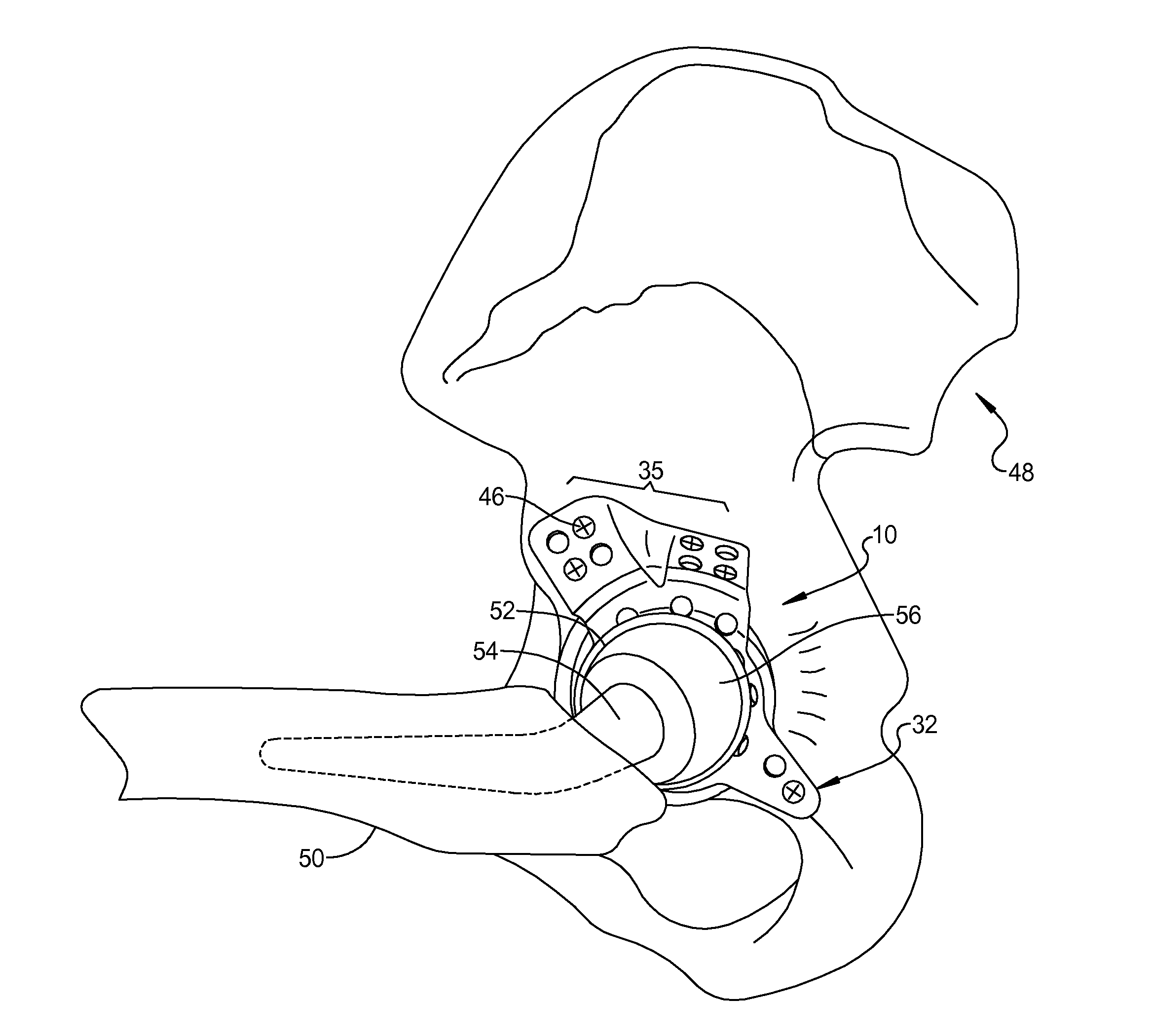 Acetabular Prosthesis