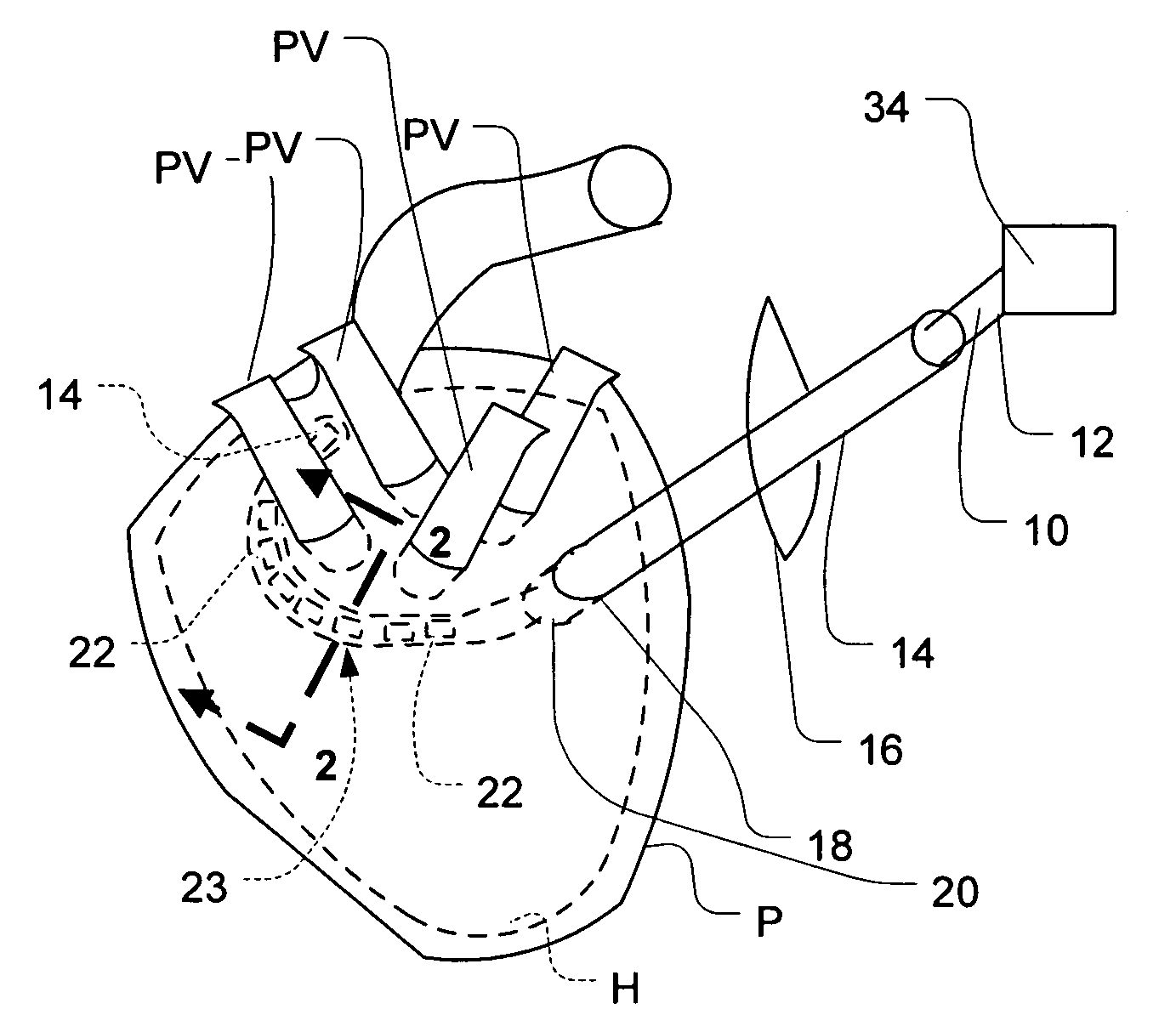 Epicardial ablation using focused ultrasound