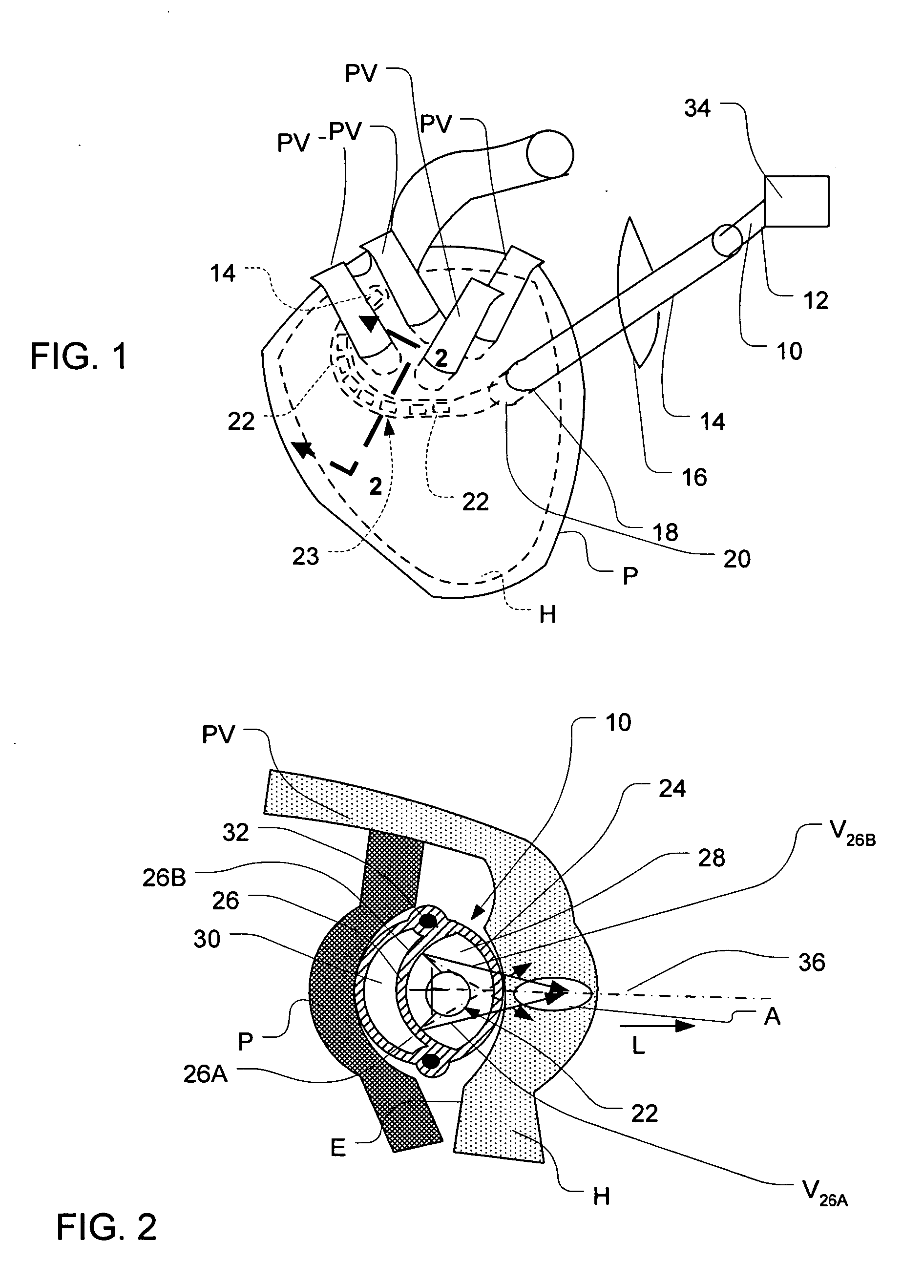 Epicardial ablation using focused ultrasound