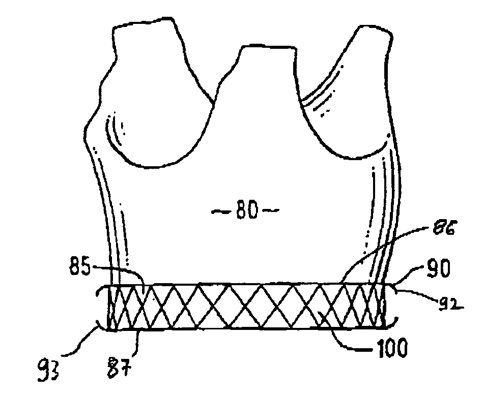 Endovascular aortic valve replacement