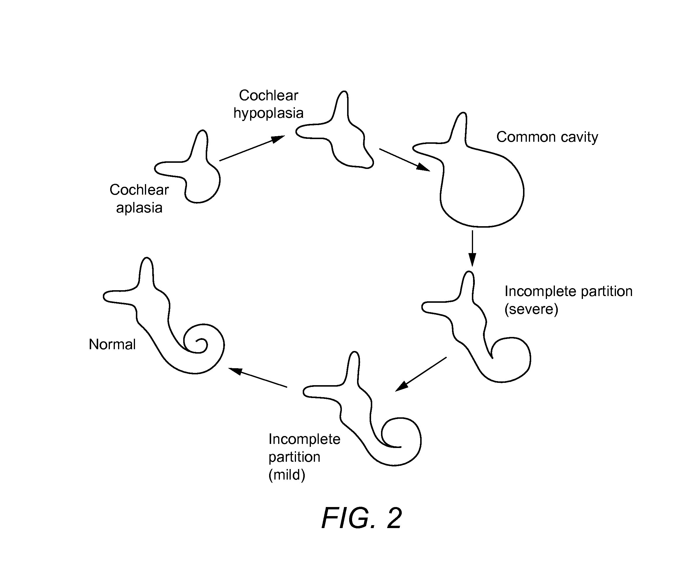 Deployable and Multi-Sectional Hearing Implant Electrode