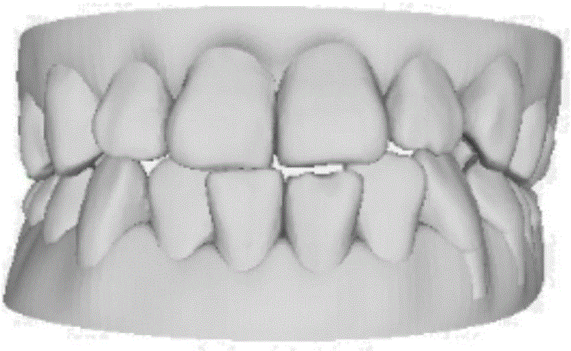 Collision detection algorithm for calculating occlusion areas of upper and lower jaws