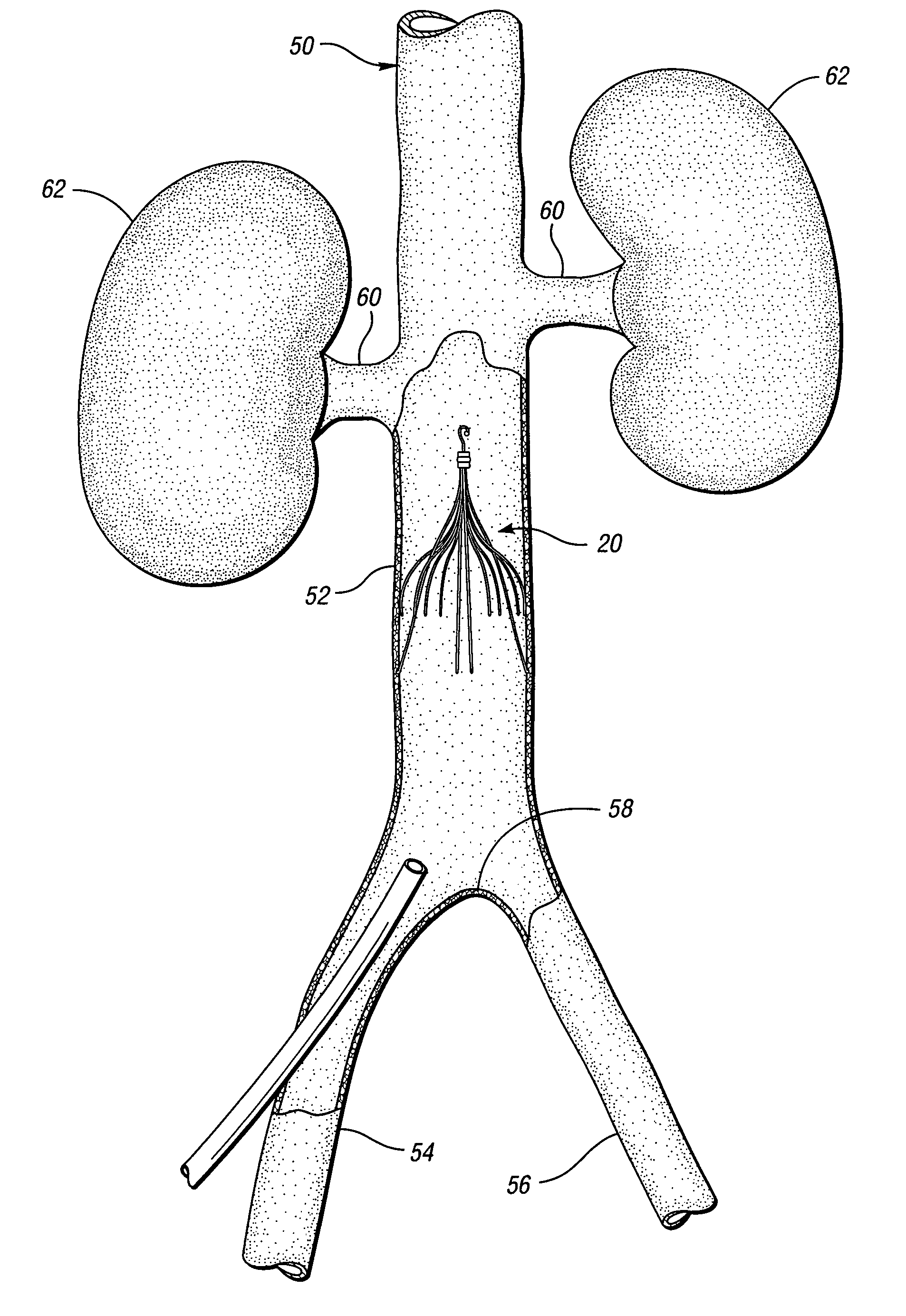 Removable vena cava filter having primary struts for enhanced retrieval and delivery