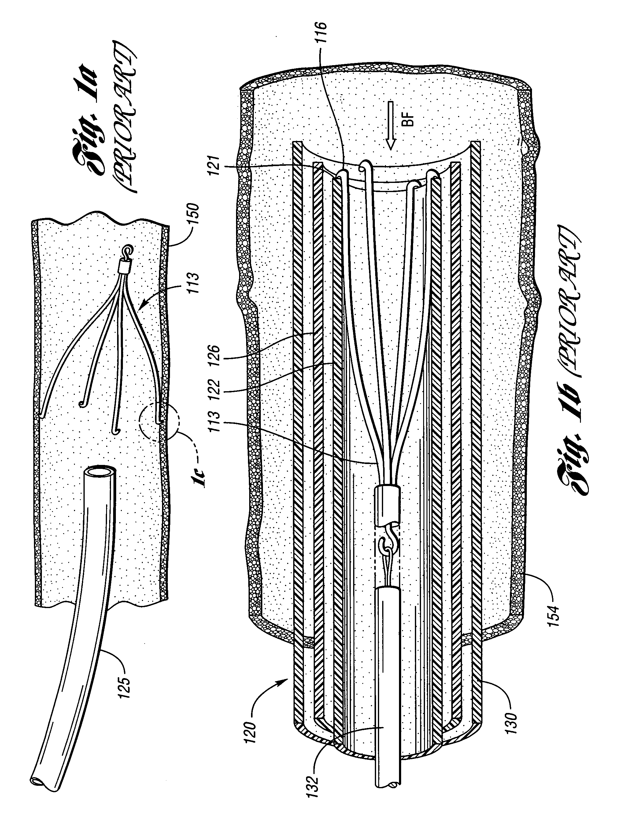 Removable vena cava filter having primary struts for enhanced retrieval and delivery