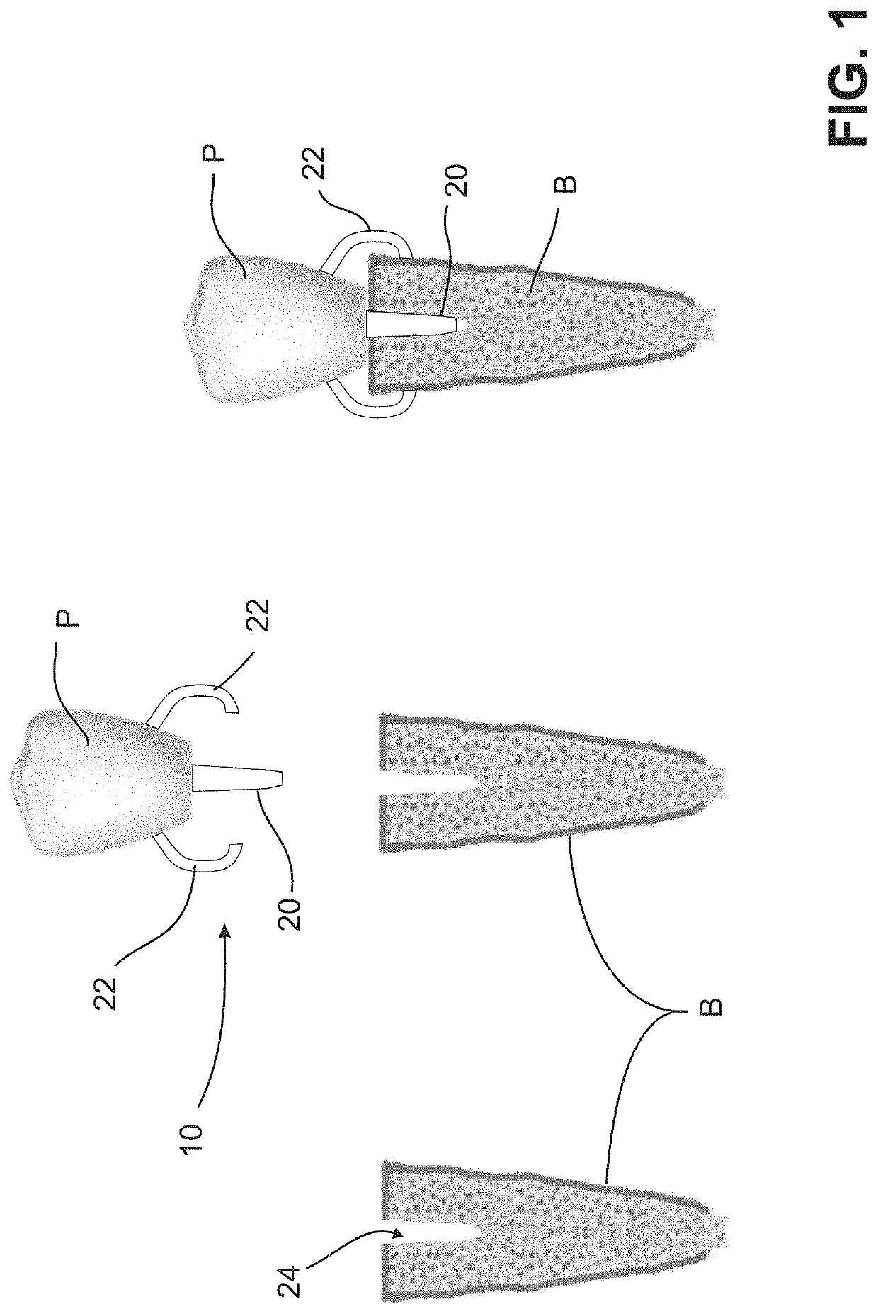 Method for dynamically guiding a dental oral and maxillofacial prosthesis