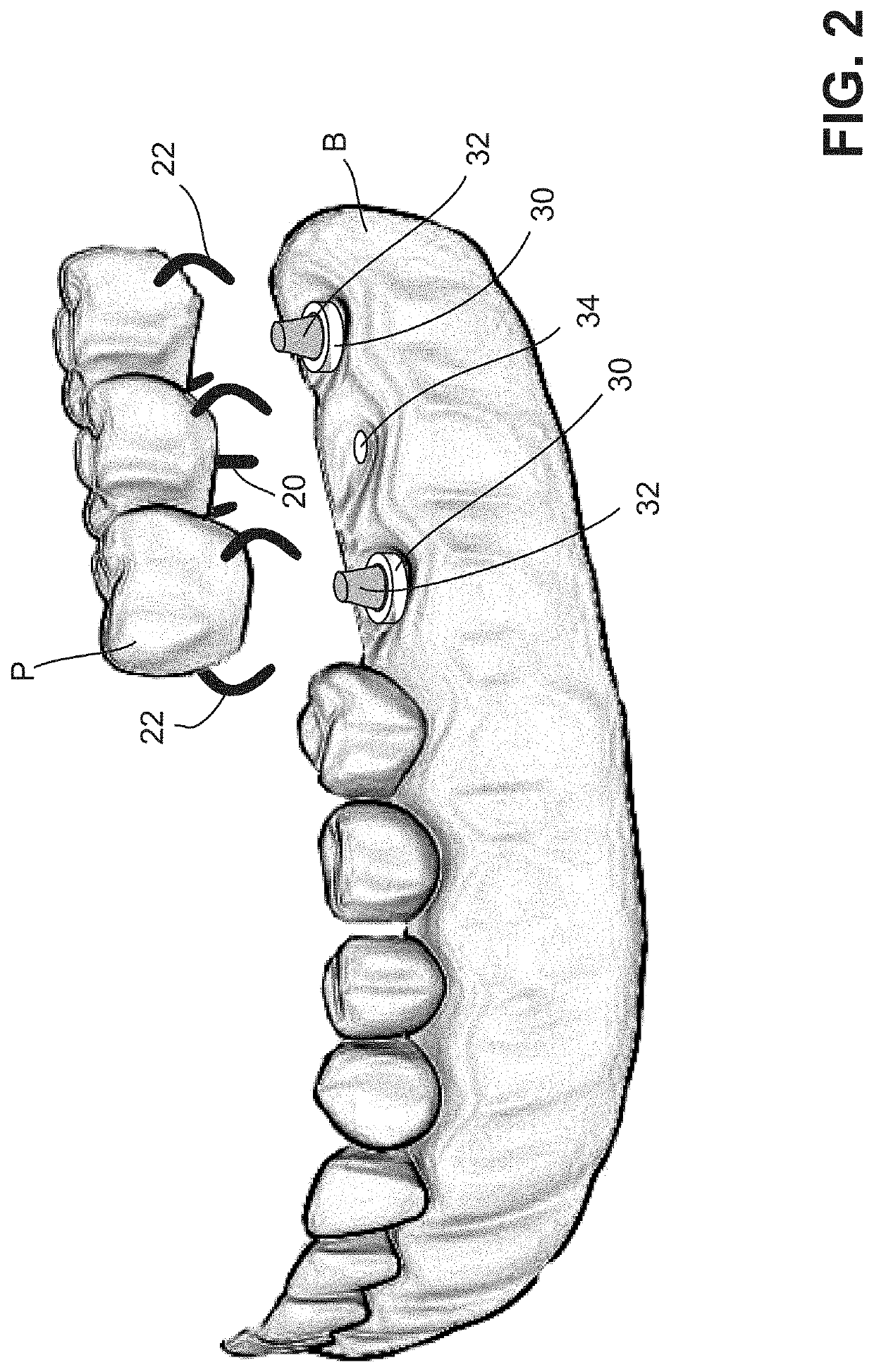 Method for dynamically guiding a dental oral and maxillofacial prosthesis