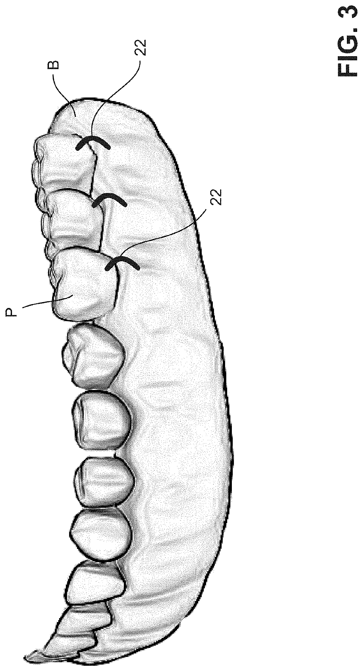 Method for dynamically guiding a dental oral and maxillofacial prosthesis