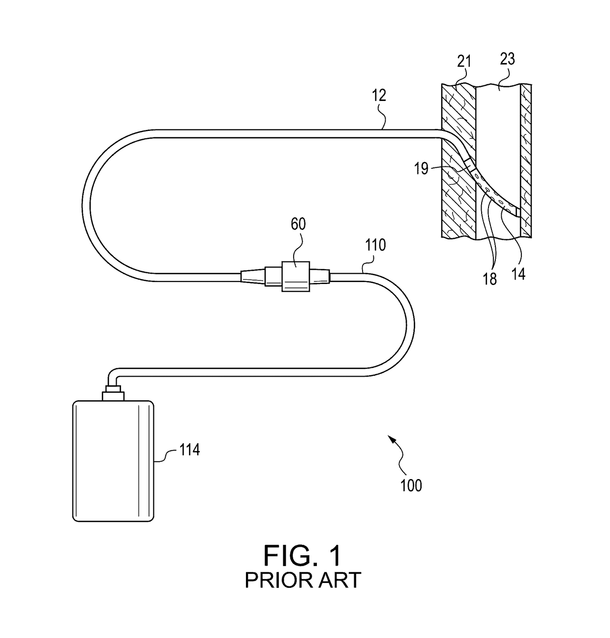 Pleurodesis device and method