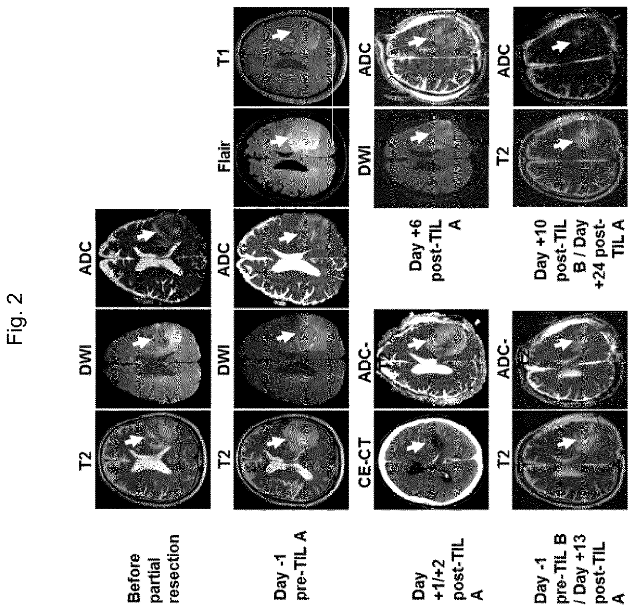 Method for the treatment of a tumor patient with adoptive t cell immunotherapy