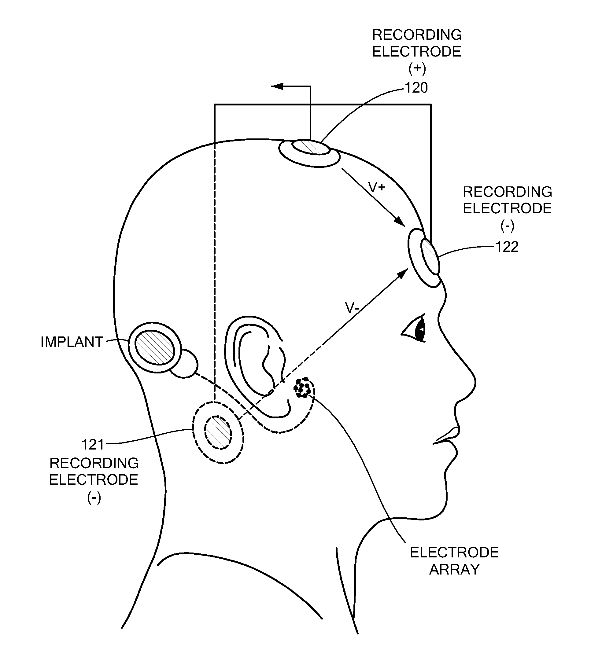 Electrically Evoked Brainstem Response Measurements via Implant Prosthesis