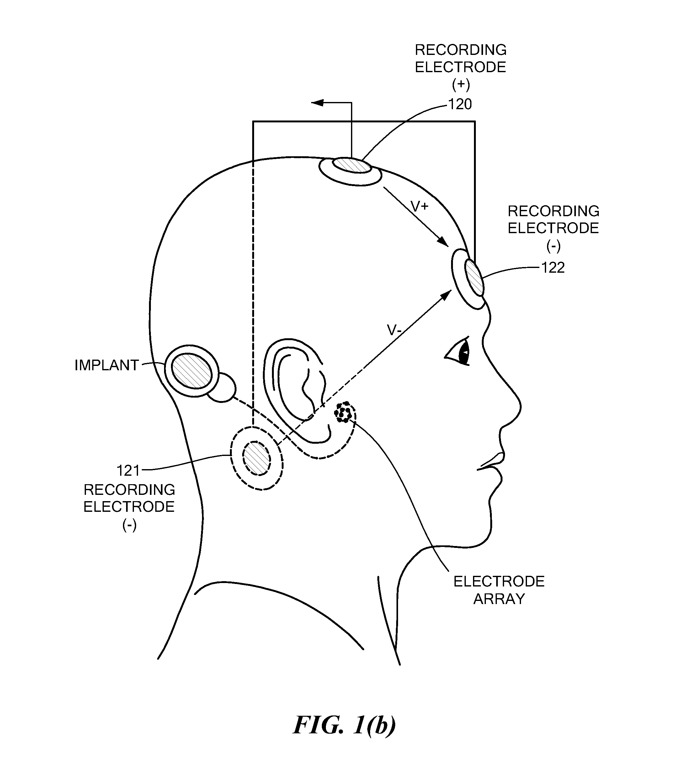 Electrically Evoked Brainstem Response Measurements via Implant Prosthesis