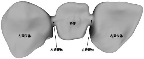 A Denture Bridge Fusion Method for Oral Restoration