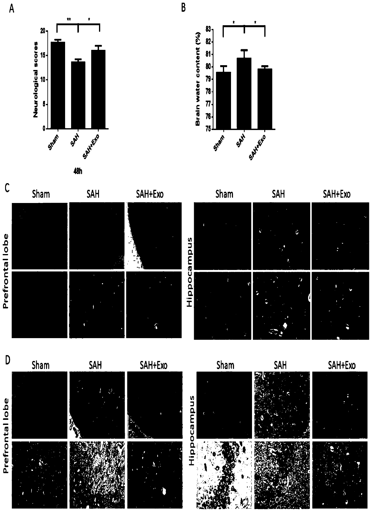 Application of miR-21 in diagnosis and treatment of subarachnoid hemorrhage