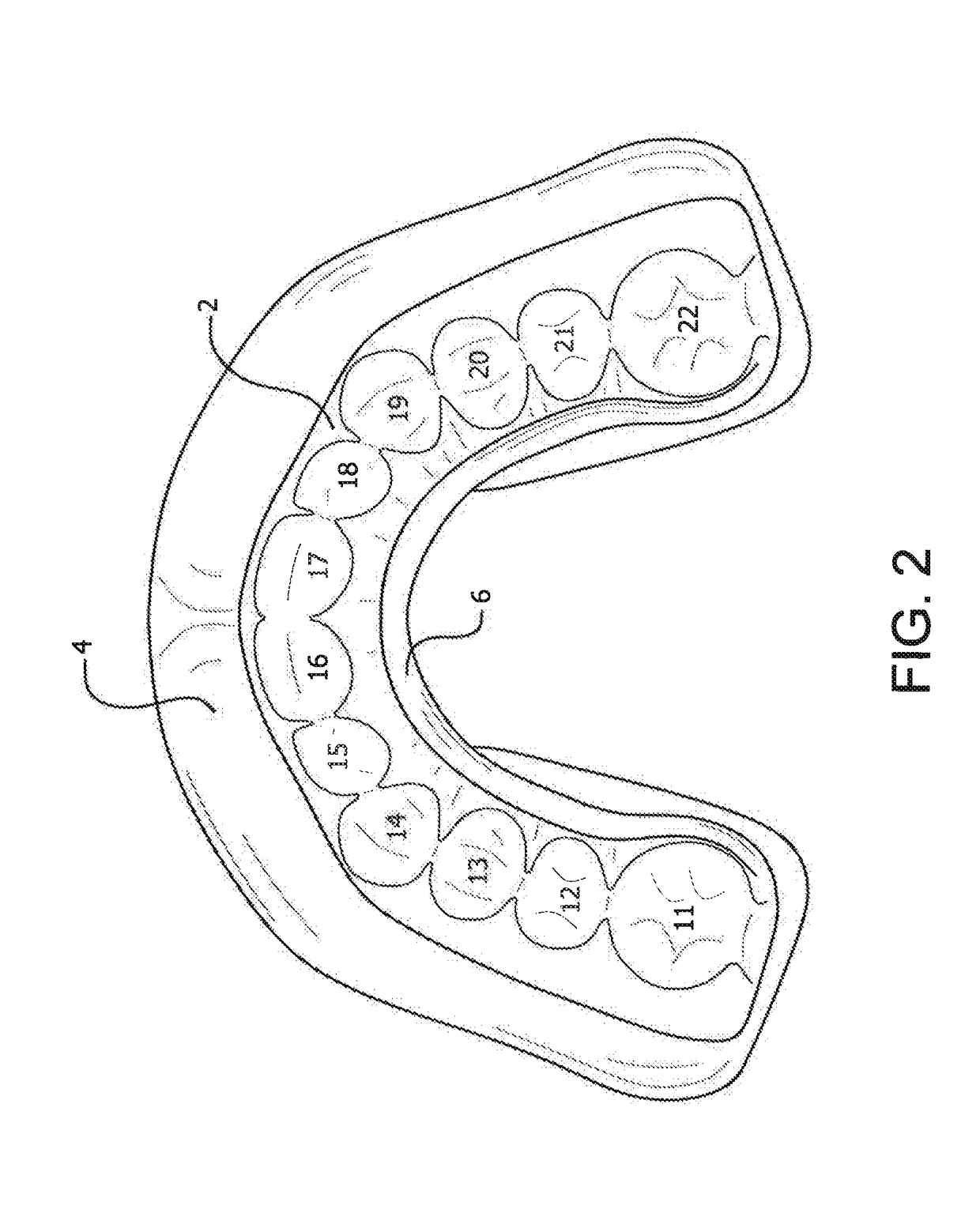 Protective Mouthguard