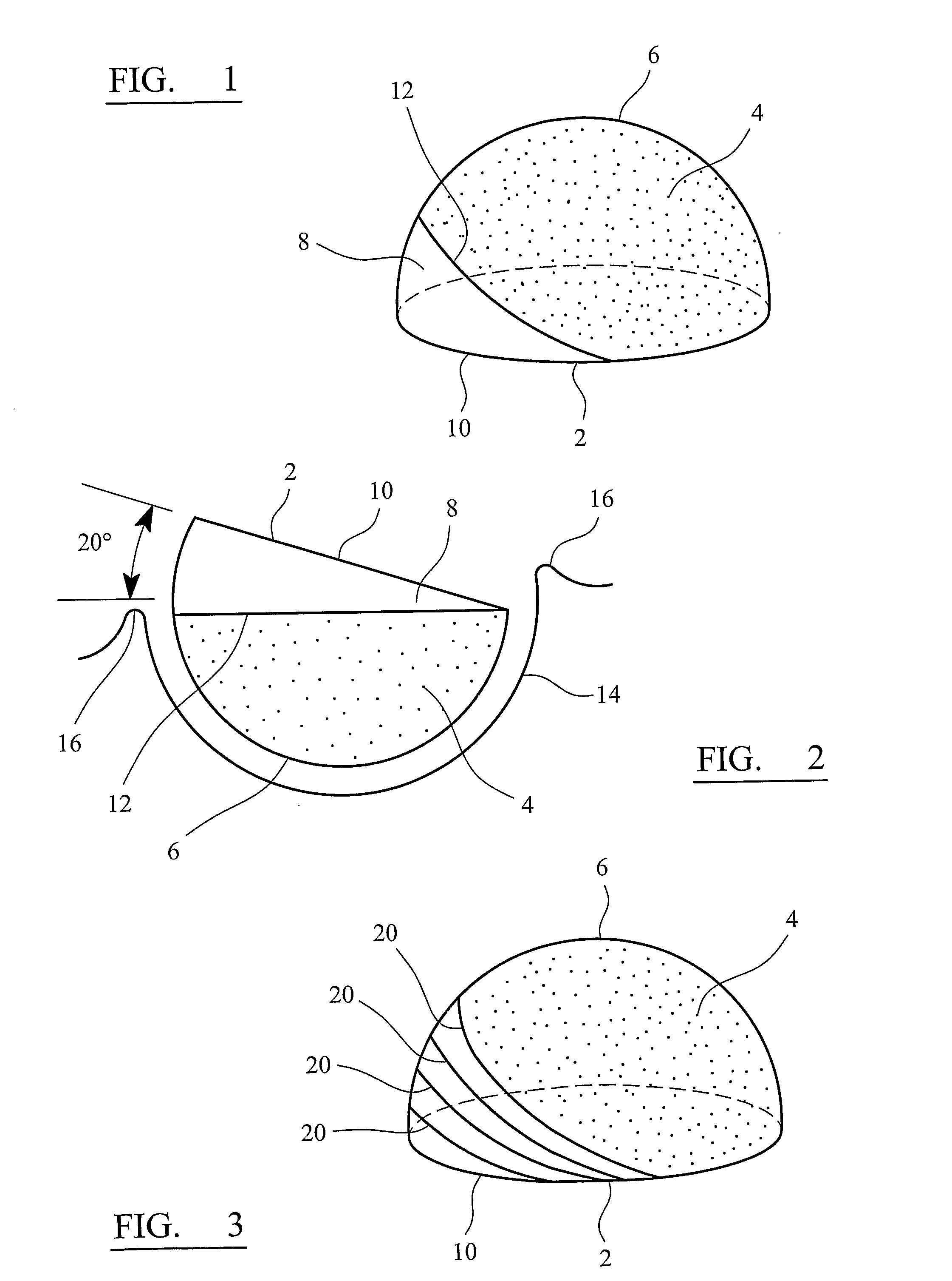 Surgical prostheses