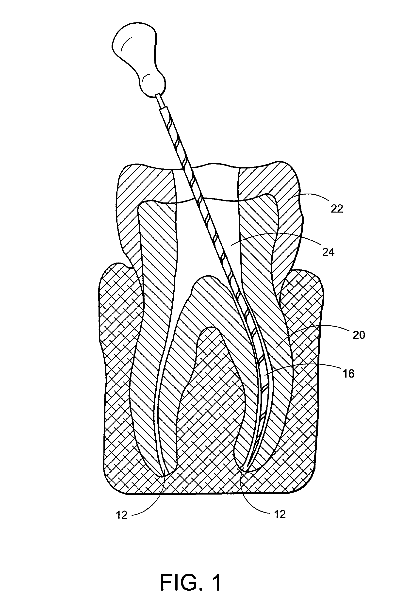 Barbed endodontic instrument