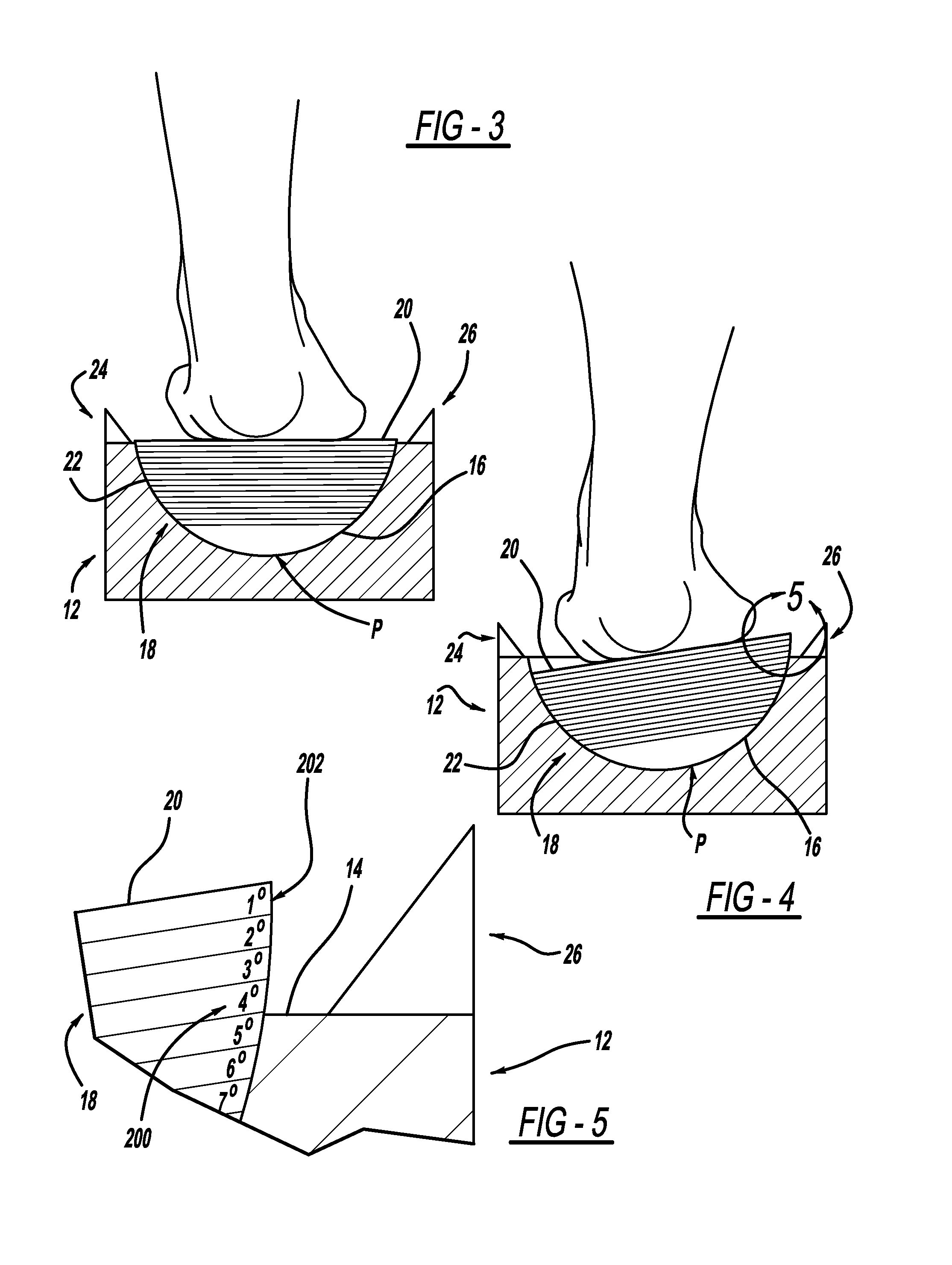 Measurement system for varus/valgus angles in feet